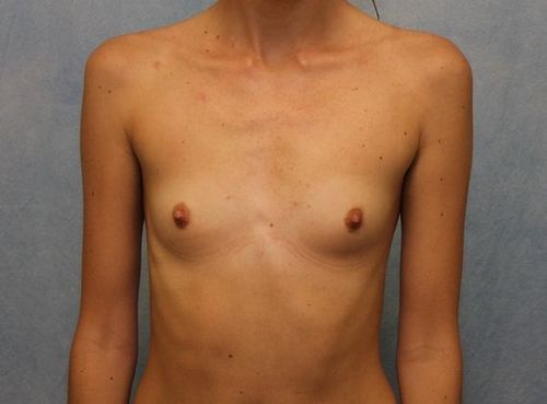 Breast Augmentation