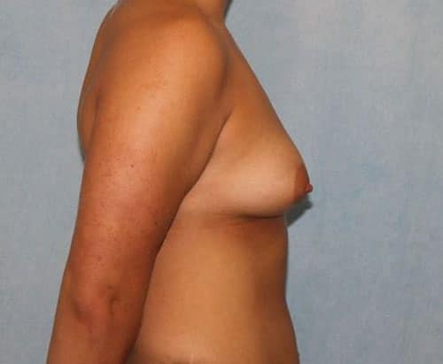 Breast Augmentation