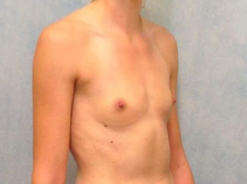 Breast Augmentation