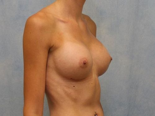 Breast Augmentation