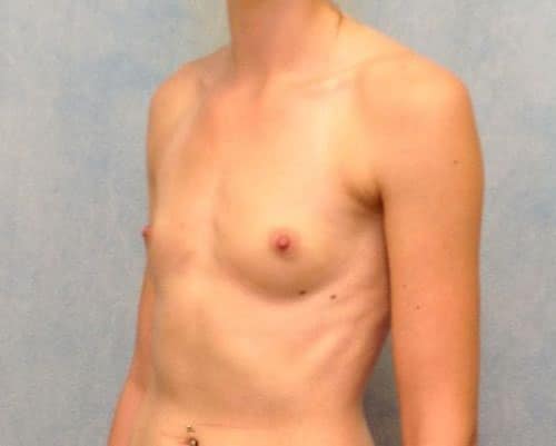 Breast Augmentation