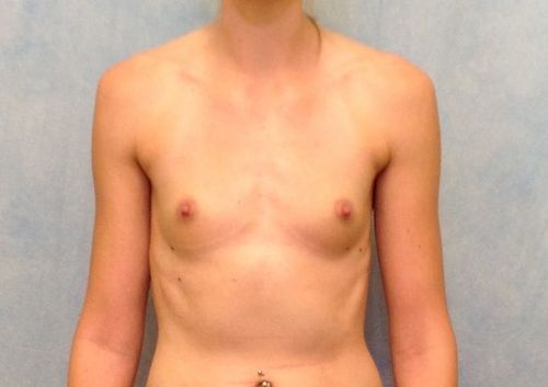 Breast Augmentation