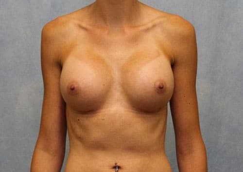 Breast Augmentation