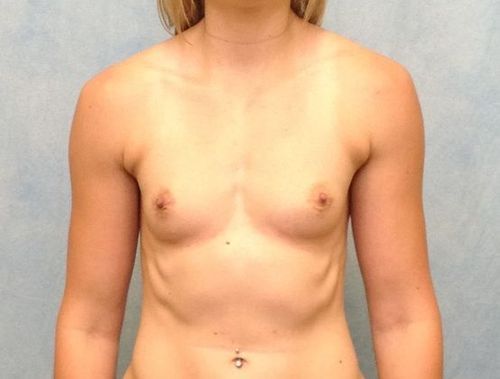 Breast Augmentation