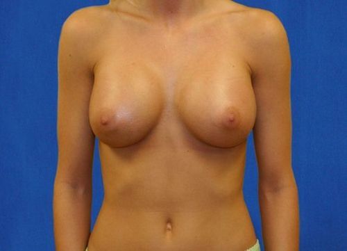 Breast Augmentation