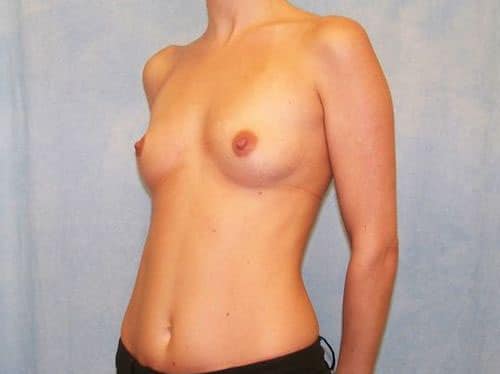 Breast Augmentation