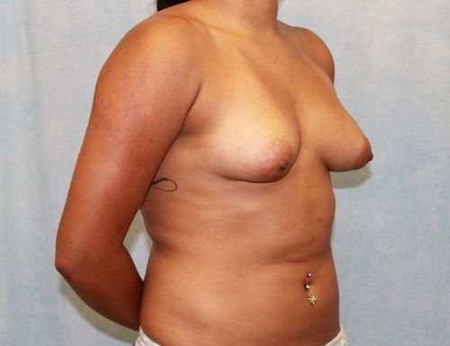 Breast Augmentation