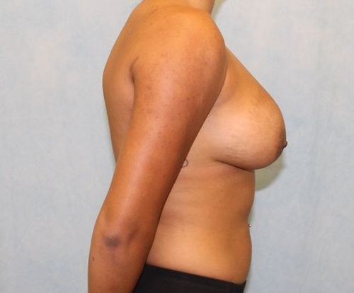Breast Augmentation