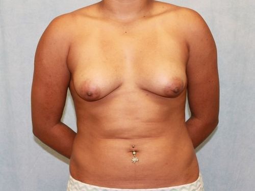 Breast Augmentation