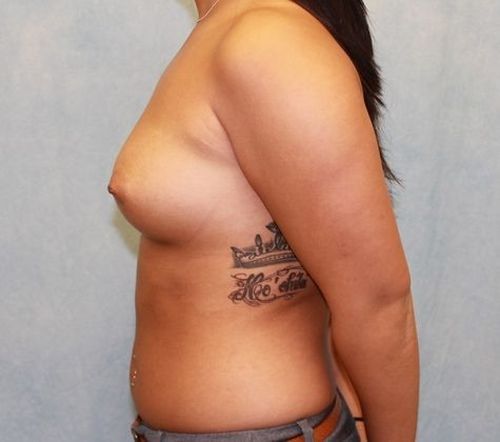 Breast Augmentation