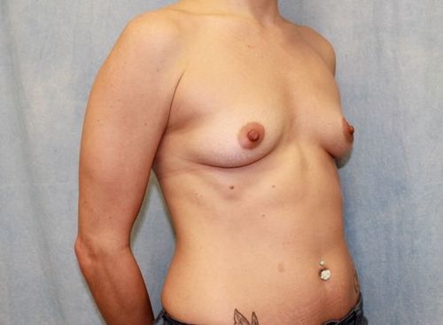 Breast Augmentation