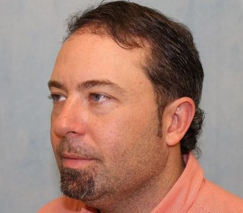 Hair Transplant