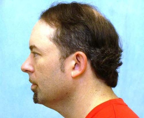 Hair Transplant