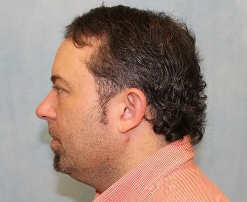 Hair Transplant