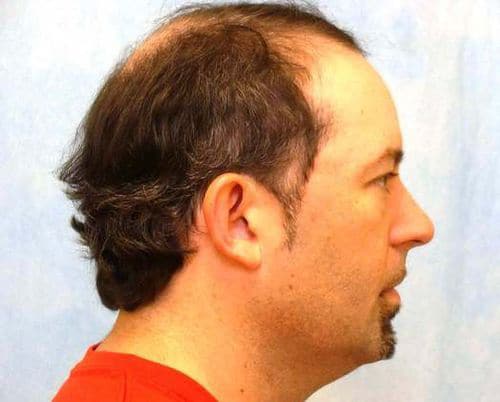 Hair Transplant