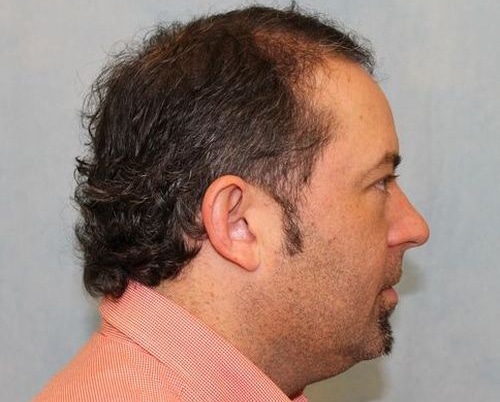 Hair Transplant