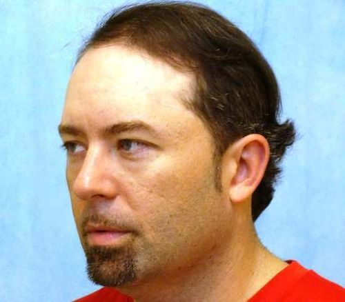 Hair Transplant