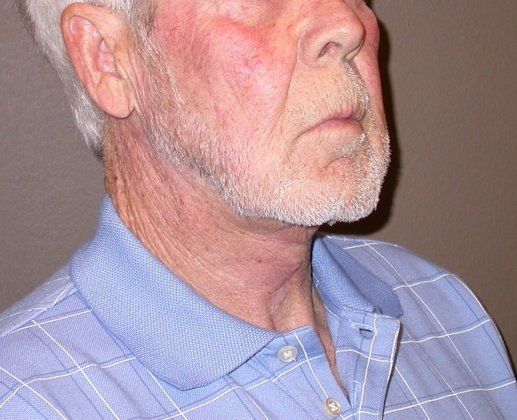 Neck Lift - Direct (For Men)