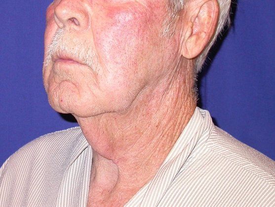 Neck Lift - Direct (For Men)