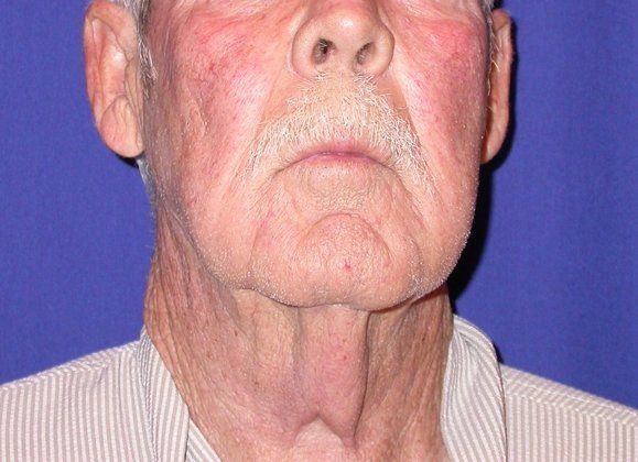 Neck Lift - Direct (For Men)