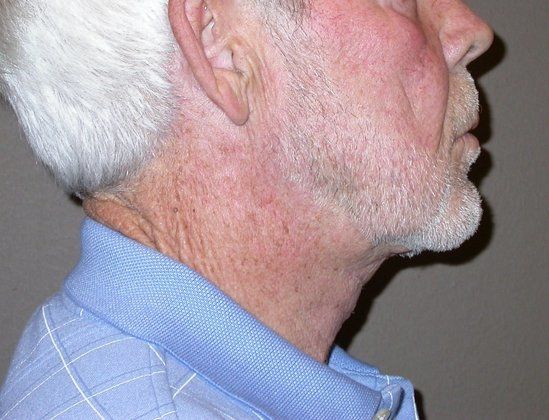 Neck Lift - Direct (For Men)