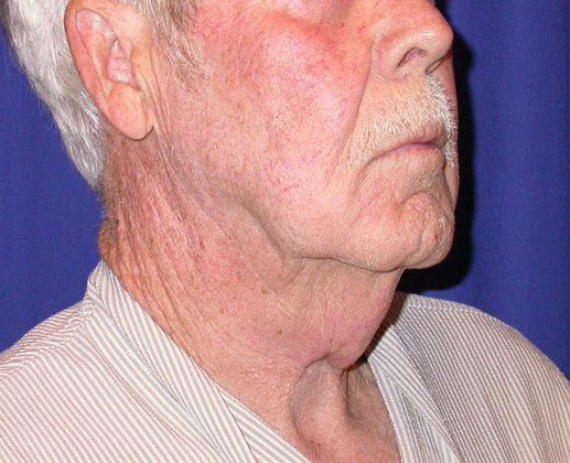 Neck Lift - Direct (For Men)