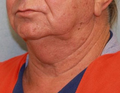 Neck Lift - Direct (For Men)