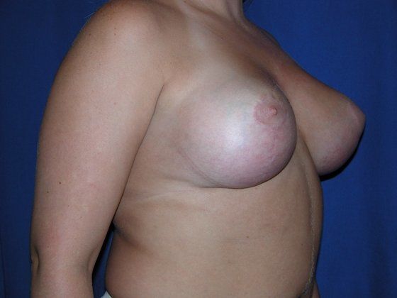 Breast Lift