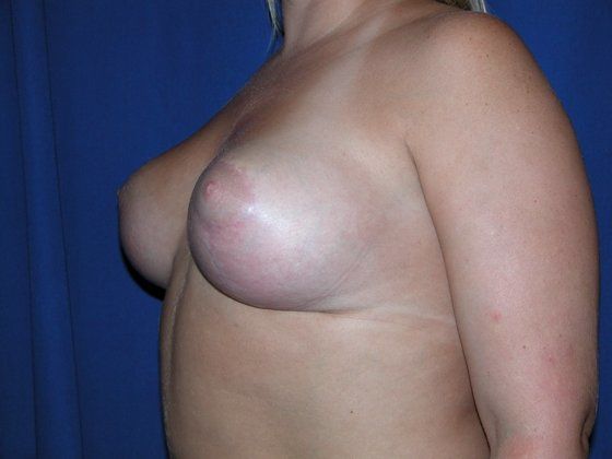 Breast Lift