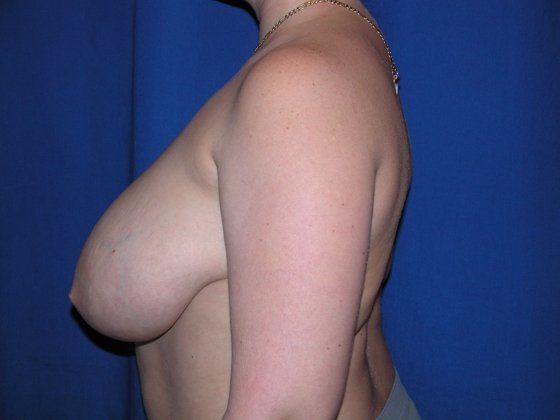 Breast Lift