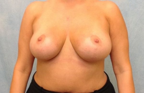 Breast Lift