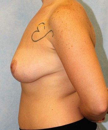 Breast Lift with Reduction