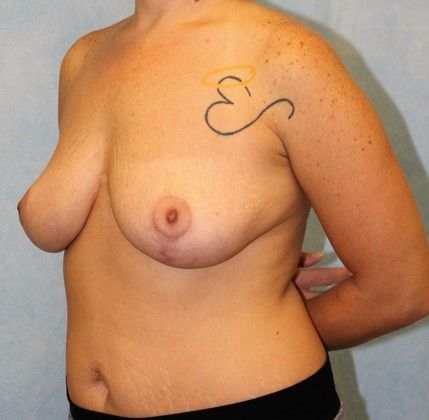 Breast Lift with Reduction