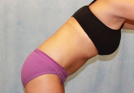 Abdominoplasty - Tummy Tuck