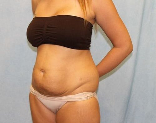 Abdominoplasty - Tummy Tuck