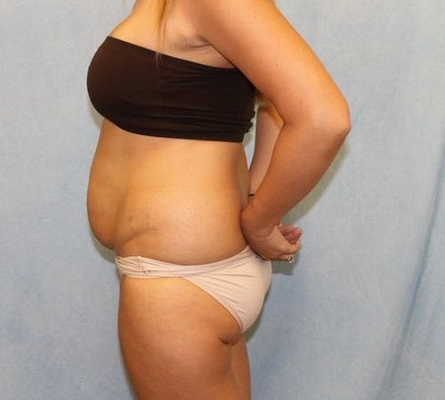 Abdominoplasty - Tummy Tuck