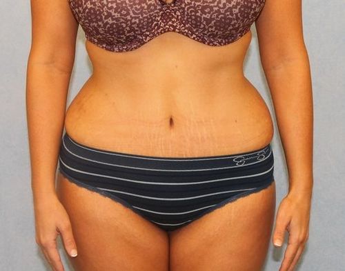 Abdominoplasty - Tummy Tuck