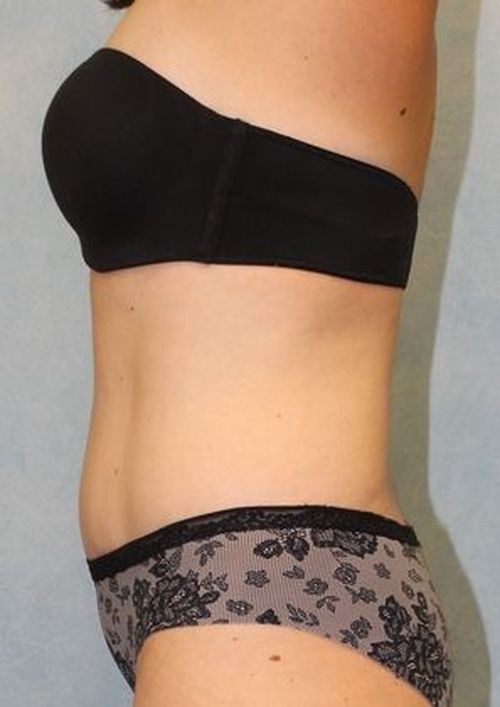 Abdominoplasty - Tummy Tuck