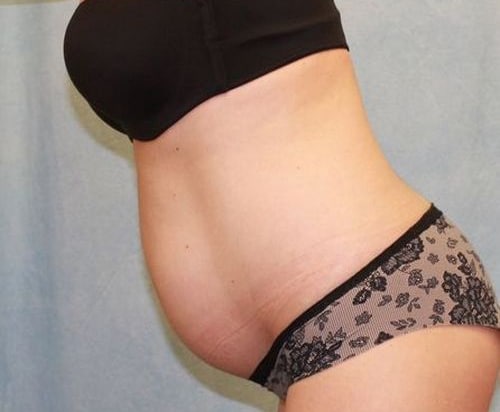 Abdominoplasty - Tummy Tuck