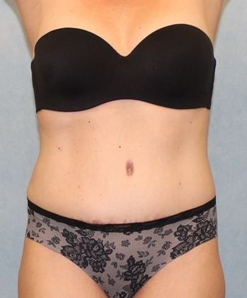 Abdominoplasty - Tummy Tuck
