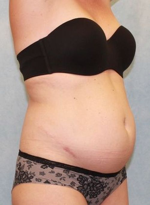 Abdominoplasty - Tummy Tuck