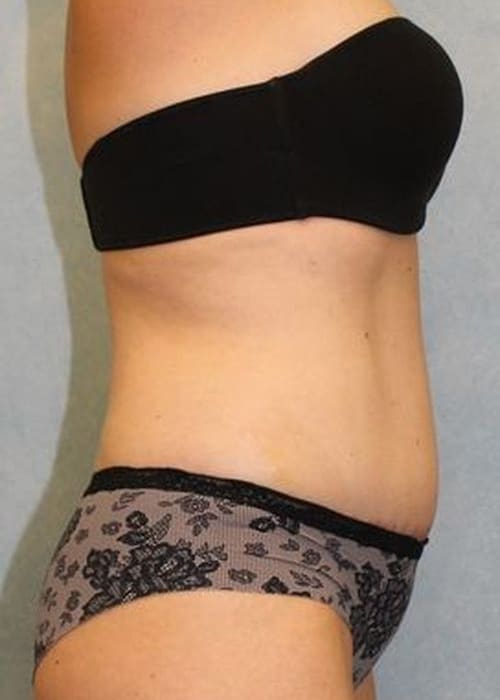 Abdominoplasty - Tummy Tuck