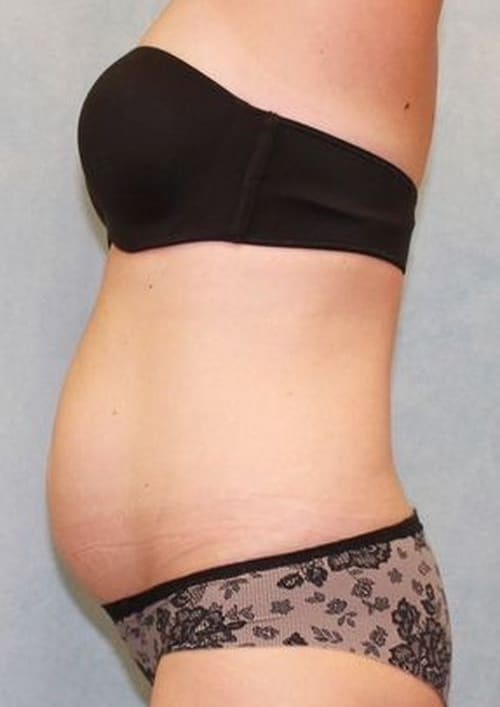 Abdominoplasty - Tummy Tuck