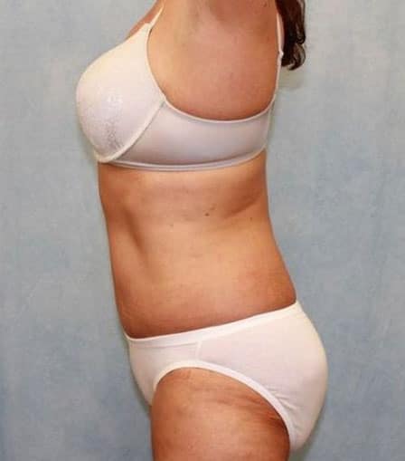 Abdominoplasty - Tummy Tuck