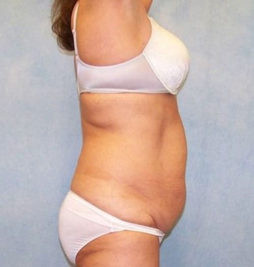 Abdominoplasty - Tummy Tuck
