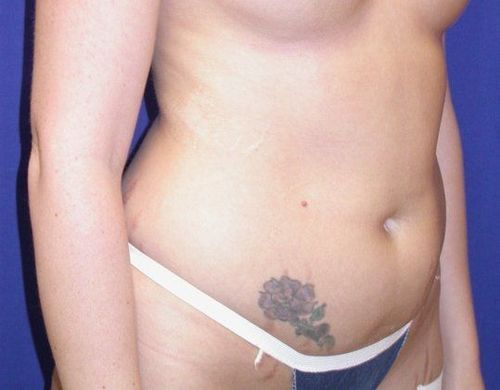 Abdominoplasty - Tummy Tuck