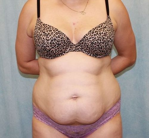 Abdominoplasty - Tummy Tuck