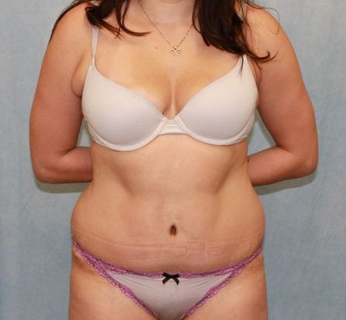 Abdominoplasty - Tummy Tuck