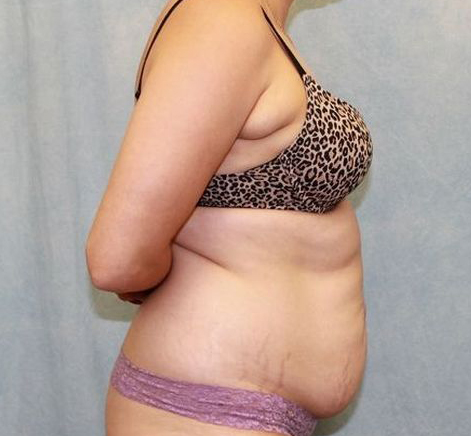 Abdominoplasty - Tummy Tuck