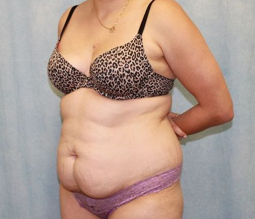 Abdominoplasty - Tummy Tuck